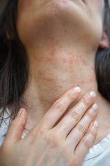 Close-up of a woman’s neck showing an allergic skin reaction with redness and irritation, likely...