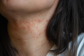 Close-up of a woman’s neck showing an allergic skin reaction with redness and irritation, likely...