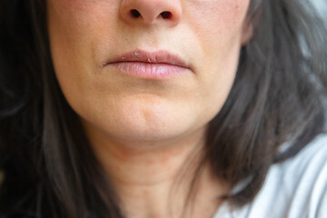 Close-up of a woman's face showing dry, cracked lips and peeling skin around the mouth and neck, suggesting dehydration or a skin condition. Taken indoors for dermatology context.