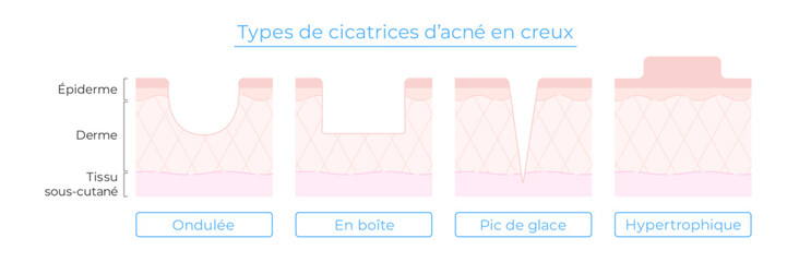 Illustration des types de cicatrices d’acné – avec coupe de la peau