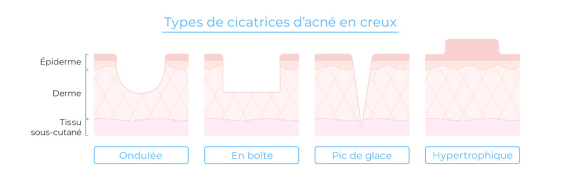 Illustration des types de cicatrices d&rsquo;acn&eacute; &ndash; avec coupe de la peau