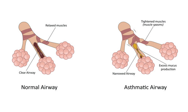 Asthma vector illustration