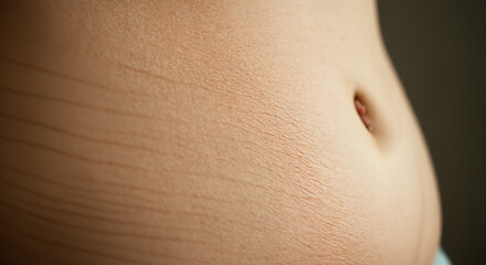 Close-up of stomach with visible stretch marks