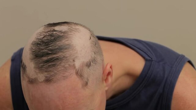 Male scalp with severe patchy hair loss and thinning hair
