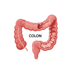 Medical illustration showing healthy colon compared to colon cancer with labeled anatomical details.