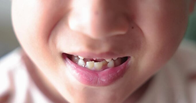 Close up of kid smiling with missing front tooth, child dental care, milk teeth falling out, childhood oral health, happy boy showing tooth gap, first lost tooth, growing up concept. 4K video.