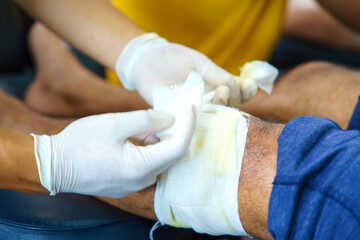 Knee pain in an elderly person use thai herbal compress ball or herbal on knee. Knee pain may cause from muscle strain, tendinosis, Knee osteoarthritis. Thai traditional medicin