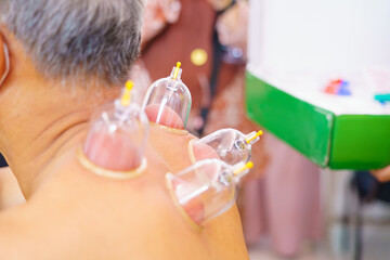 Close up for multiple vacuum cups, medical cupping therapy on human body. Doctor with cups for patient, therapy. Wellness, health injury rehabilitation concept. Alternative medicine