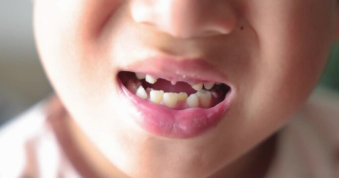 Close up of kid smiling with missing front tooth, child dental care, milk teeth falling out, childhood oral health, happy boy showing tooth gap, first lost tooth, growing up concept. 4K video.