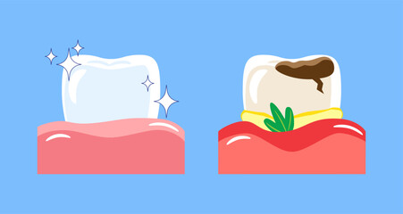 Periodontal disease . Included gingivitis, dental calculus, gum recession and food stuck in teeth . Cartoon illustration . Isolated on blue background . Vector .