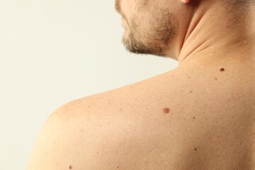 Man with moles on his skin against light background, closeup