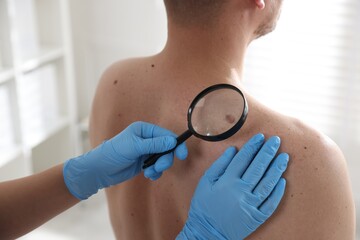 Doctor examining man's moles in hospital, closeup