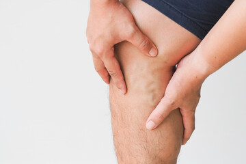 Varicose veins on the legs of men