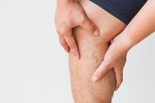 Varicose veins on the legs of men