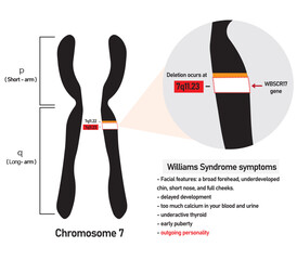Williams syndrome is a genetic disorder resulting from the loss of multiple genes in the 7q11.23 region of chromosome 7.