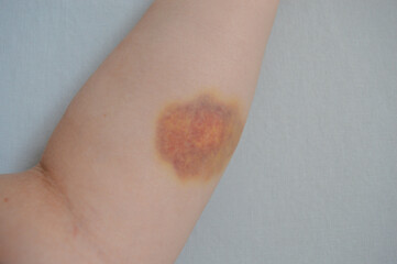 Bruise on human forearm. Close-up of hematoma on pale skin, medical injury concept, trauma recovery, domestic accident or healthcare theme.