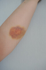 Bruise on human forearm. Close-up of hematoma on pale skin, medical injury concept, trauma...