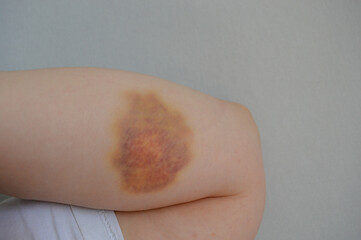 Bruise on human forearm. Close-up of hematoma on pale skin, medical injury concept, trauma...