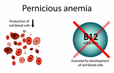 Pernicious Anemia Illustration with Vitamin B12 Deficiency. Medical Diagram Showing Reduced Red Blood Cells in B12 Deficiency. Infographic of Pernicious Anemia and Vitamin B12 Importance