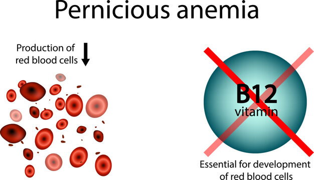 Pernicious Anemia Illustration with Vitamin B12 Deficiency. Medical Diagram Showing Reduced Red Blood Cells in B12 Deficiency. Infographic of Pernicious Anemia and Vitamin B12 Importance