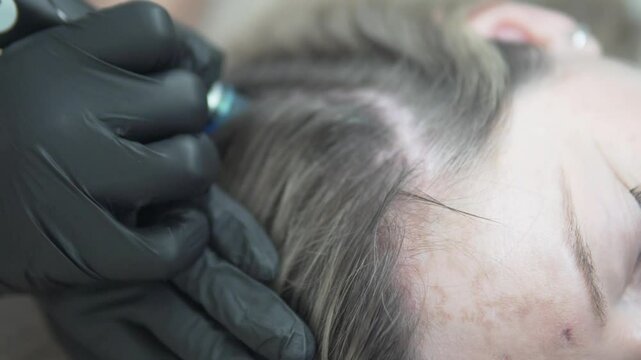 Close-up of a scalp hair loss procedure for a young woman using a modern Hydrofashion device