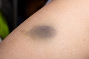 Closeup image of an arm showing a purple spot on it