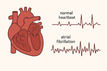 Atrial fibrillation vector illustration. Comparison of normal heartbeat and AFib heart rhythm on an ECG. Medical diagram showing heart anatomy and arrhythmia. Cardiology concept.