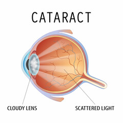 Human eye with cataract. Diagram and structure of the eyeball with a cloudy lens. Isolated on white background. Vector illustration.