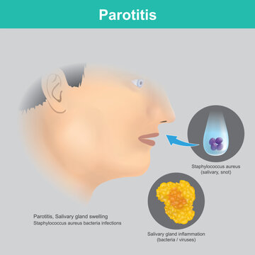 Parotitis: Salivary Gland Inflammation and Infection.