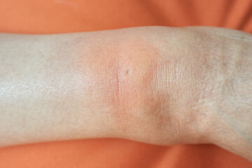 Female ankle stung by a wasp