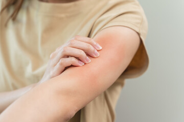 young woman scratching on her arm and has a red rash irritation on her skin from dust intolerance.