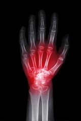 X-ray Wrist Joint Showing Carpal Tunnel Syndrome Nerve Compression