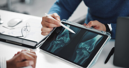 Doctor, patient and hands on tablet screen for knee x ray with injury, osteoporosis or tendon...