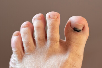 Close-up of a human foot with a bruise under the big toenail