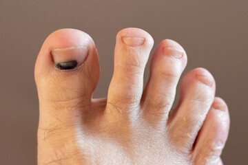 Close-up of a human foot with a bruise under the big toenail
