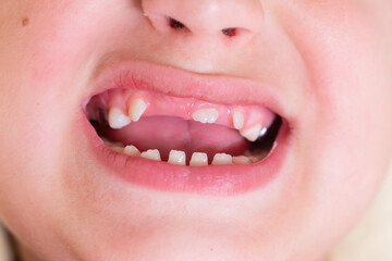 Close-up of Baby's First Teeth Coming Through Gums