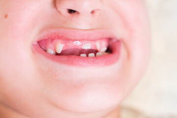 Close-up of Baby's First Teeth Coming Through Gums
