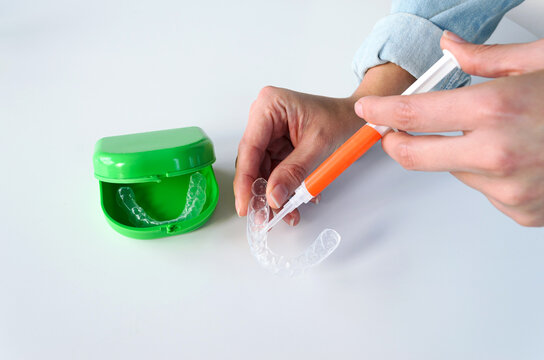 Aplicaci&oacute;n de per&oacute;xido de carbamida con jeringa en f&eacute;rula personalizada. Blanqueamiento dental. 