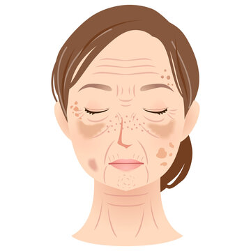 シミができた女性の顔　美容　シニア女性