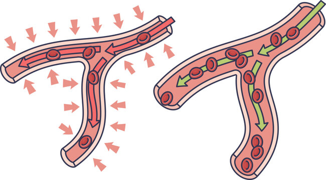 Illustration of blood vessel constriction and normal flow with arrows and red blood cells.