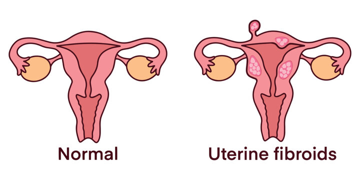 Visual comparison of normal uterus and uterus with fibroid tumors. Used in medical education, patient explanation, and gynecology reference