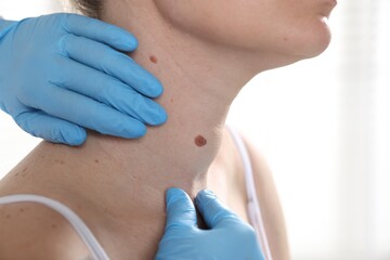 Doctor examining woman's moles in hospital, closeup