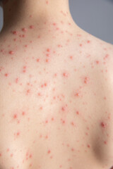 Chickenpox. Rash on the boy's body. The child has chickenpox. Red spots on the back. Childhood...