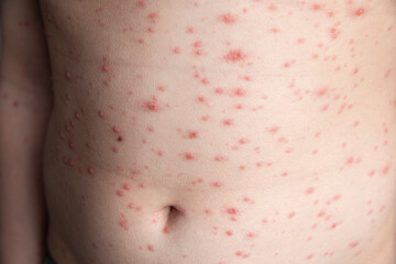 Chickenpox. Rash on the boy's body. The child has chickenpox. Red spots on the back. Childhood...