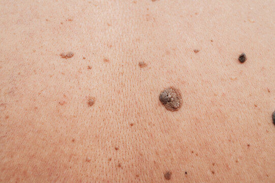 Human skin with freckles, aging sports, black and brown males and warts, wrinkles