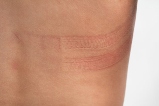 Bra marks on the back. The girl rubbed her back with her underwear. Uncomfortable bra. The wrong size underwear. Traces of clothing on the body.
