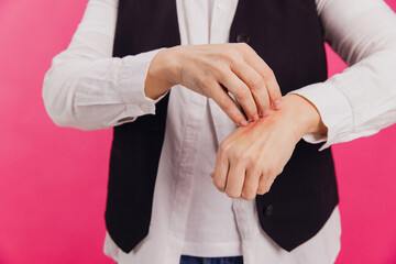 Woman scratching itchy red rash on wrist, concept of allergies and skin diseases