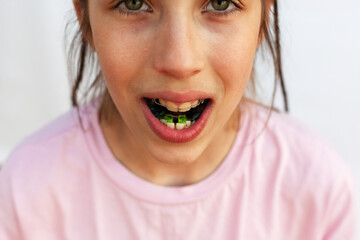 Top view girl with open mouth shows arches of orthodontic plates uneven teeth, malocclusion on white background