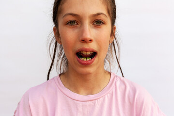 Girl with open mouth shows arches of orthodontic plates uneven teeth, malocclusion on white background