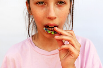 Young girl in pink t-shirt putting orthodontic plate on teeth with uneven teeth, malocclusion on white background. Concept orthodontic treatment
